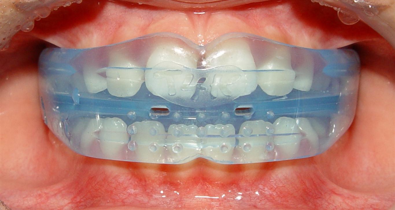 Myobrace